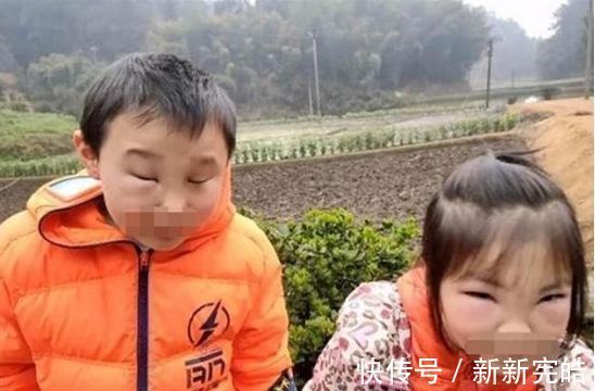 肥皂水|哥哥带着妹妹捅马蜂窝,却被蛰成“猪头”,妈妈迟迟不敢相认