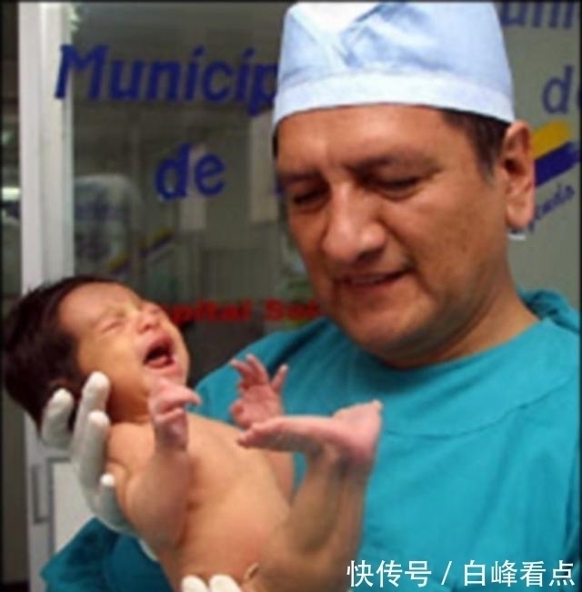 希洛|现实美人鱼女孩:没有双腿长了“人鱼尾”,却从未停止摇摆尾巴