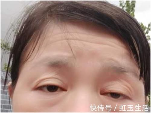 黑眼仁|上睑下垂眼无神，做个双眼皮手术就能搞定吗？