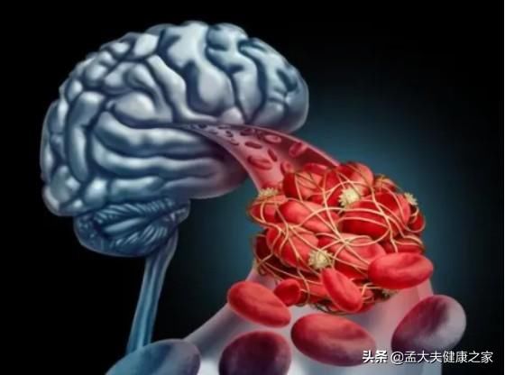 此文|老年人预防脑梗与老年痴呆，如何补充叶酸与B12很重要，请看此文