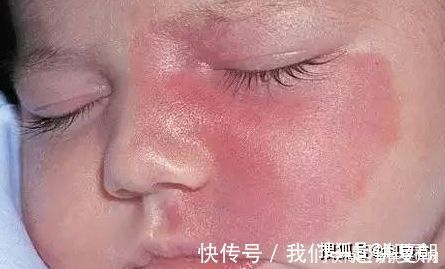 怀孕期间|不想宝宝长胎记？妈妈怀孕期间要尽量避免这4件事