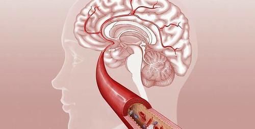 脑梗会二次复发？中老年人做好3件事，或能预防