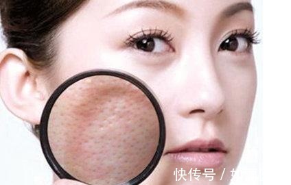 光子嫩肤 毛孔粗大怎么办?最全缩毛孔医美项目合集!