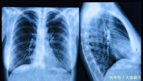 癌症|上半身一个表现，可能暗示肺部发生癌变，4类人最好早做CT排查