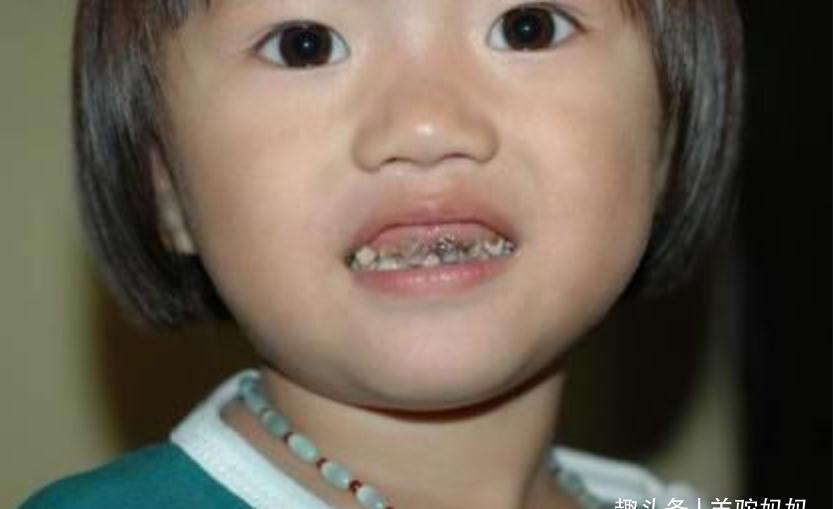 牙齿|让娃满口“小黑牙”的始作俑者并非糖,而是这东西,多数父母不知