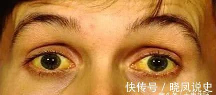 肝治|百病从肝治！灸5穴吃3宝，养肝、疏肝、护肝，肝“净”百病消！