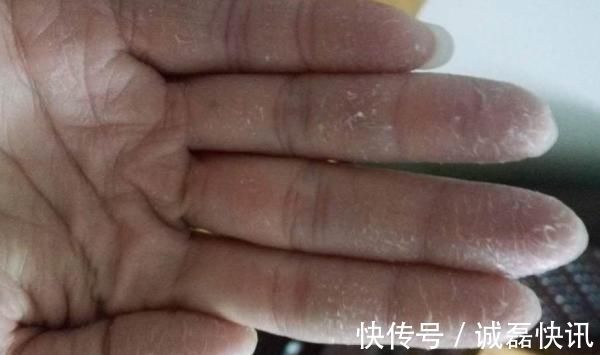 小半杯|夏天手脱皮很难看?加点厨房里的它搓一搓,1块钱解决手脱皮