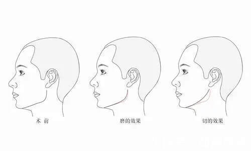 切除 下颌角削骨后有哪些后遗症？术后需要注意事项有哪些