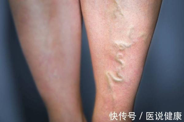 静脉|下肢出现这4种异常,当心静脉曲张已找上门,及时检查,别忽视