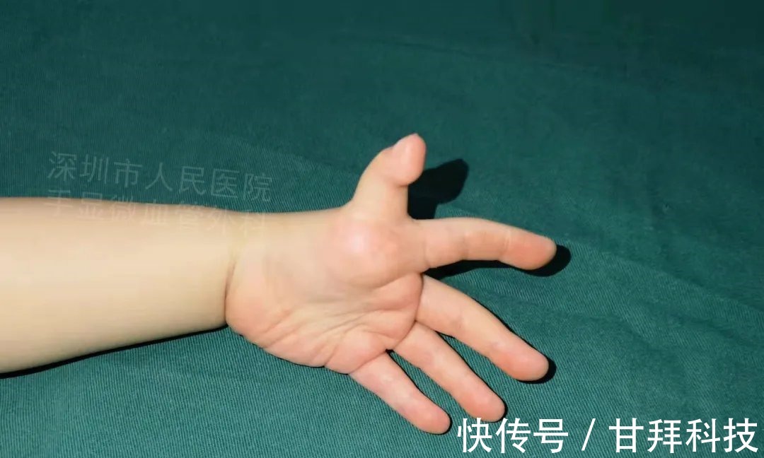 男孩|得了这病，12岁男孩手指比香蕉还粗！7种常见的手部畸形，家长们要注意