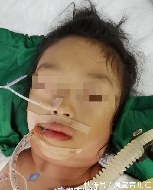 淋巴结肿大|家长注意!女童发烧发成“大脖子”,检查竟是化脓性淋巴结炎