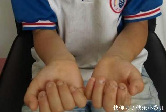 手指甲|从小“咬指甲”的孩子,长大后会变成啥样专家逃不过2种结局