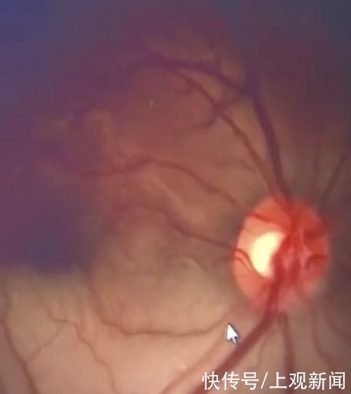 男子|熬夜玩手机,一男子醒来后突然失明了……习惯用这些姿势的要注意了