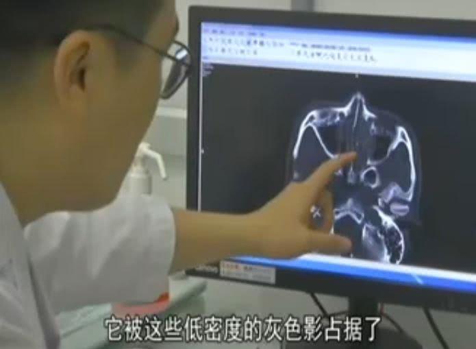 医生|小伙被大鼻涕堵的快要窒息了，医生没办法，只能用剪刀剪断了