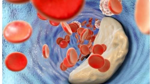 医生|动脉粥样硬化有何危害？是否真的能够被逆转？听听医生怎么说