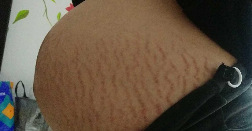 怀孕|怀孕7个月的孕妈每天抹油,但还是长了妊娠纹,医生的一句话扎心了
