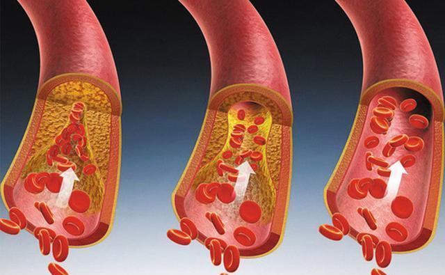 甘油三酯|高血脂不能碰“牛奶”？医生：甘油三酯超标，这2物还需尽早拉黑