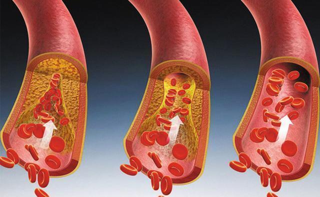 甘油三酯|高血脂不能碰“牛奶”?医生:甘油三酯超标,这2物还需尽早拉黑