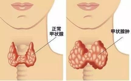 子宮肌瘤|體檢查出這10種病基本不用治，千萬別自己嚇自己！