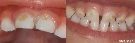 奶瓶|如何预防奶瓶龋,宝妈们知道吗?