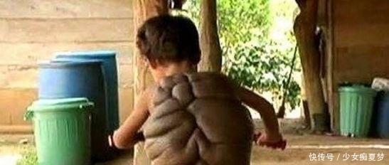 不料|男孩背后长肉瘤，后变“忍者神龟”，家人愁眉不展，不料发生奇迹