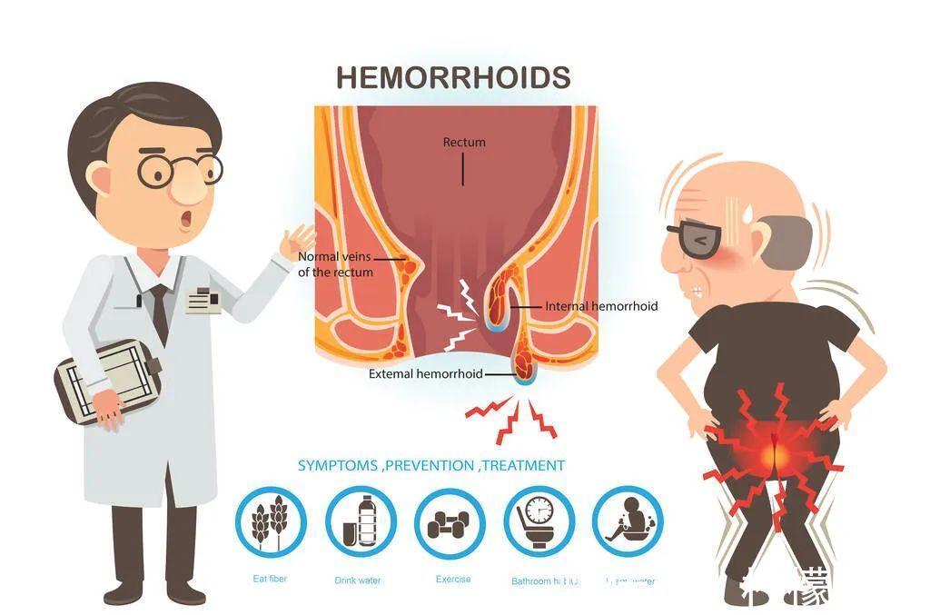 内痔|得了痔疮,吃药管用吗?会不会癌变?5个痔疮小问题,一文讲清