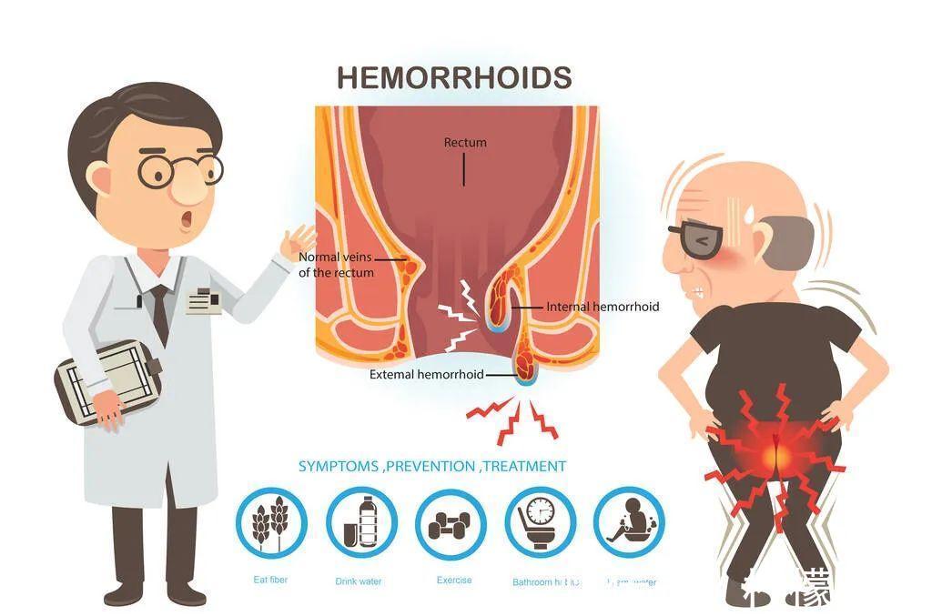 内痔|得了痔疮，吃药管用吗？会不会癌变？5个痔疮小问题，一文讲清