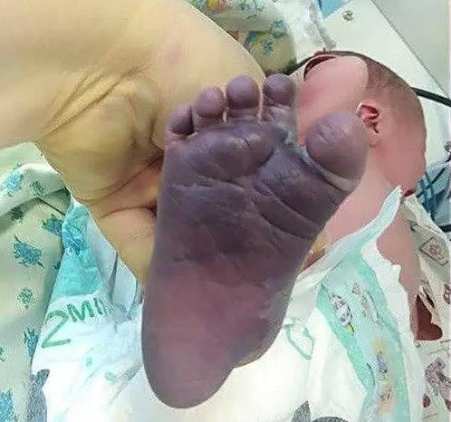 白天生|助产士接生太粗暴,蛮力拽双腿助产,双脚变紫蓝色