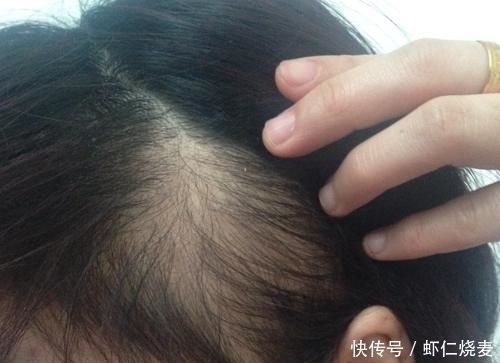 太阳穴|头发若有这四种表现,意味着你的肝脏可能在“中毒”,别不当回事