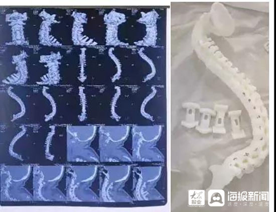 髋关节|“折叠人”复原了！依托3D打印技术，身高0.9米的她恢复到1.5米