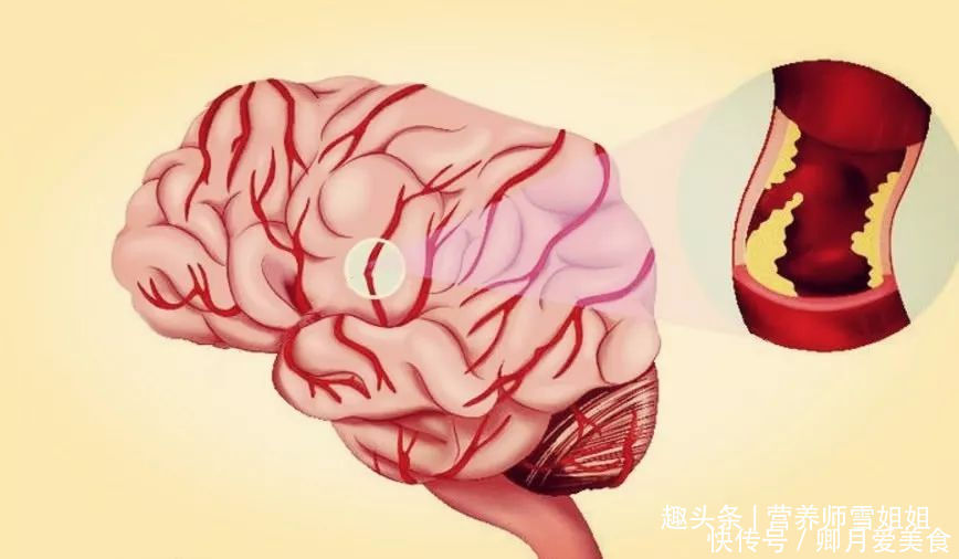 女子|43岁女子，头晕眼发黑，查出脑梗，只因一种“零嘴”吃太多