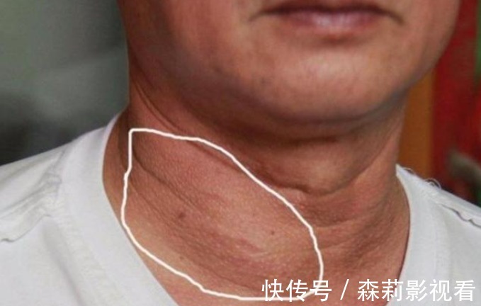 胆固醇|甲状腺结节不能吃葡萄吗?建议:这3类食物,再馋也不要贪吃