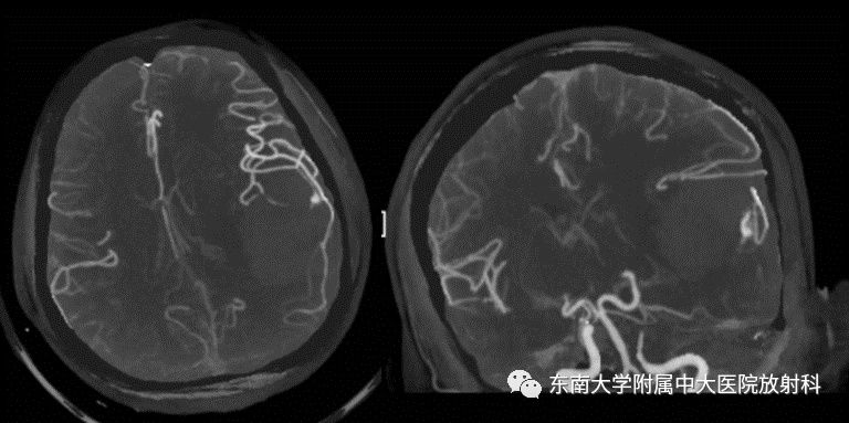 脑动静脉畸形 影像表现