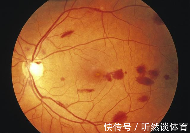 空腹|空腹血糖与餐后血糖,哪个更重要?弄不明白,血糖基本等于白测