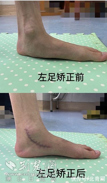 The pain in the legs of high school students running is unbearable, but the root of the disease is on the soles of the feet