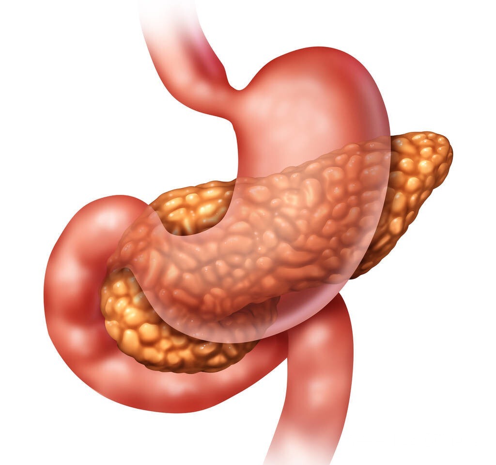 胰腺癌|女子口渴、尿多，以为是糖尿病，直到上腹部不适医生才发现是癌症