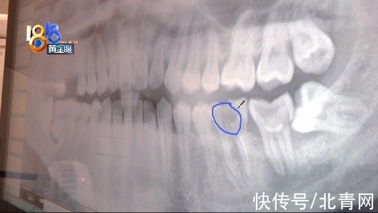 主任|拔牙进行过半，医生请来主任？