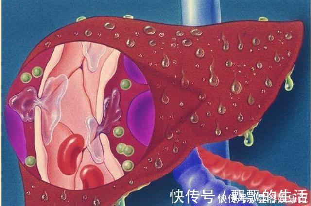 化疗|22岁妹子罹患肝癌，医生建议肝移植，妹子思考良久：不做