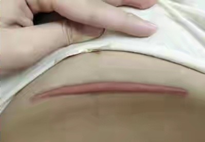 切口 手术后为什么会留疤?