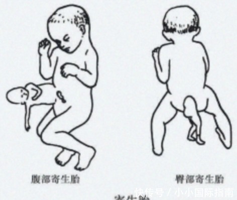 畸形|刚出生的双婴儿“第二个宝宝头颅”长在肚子上,心疼妈妈跟宝宝