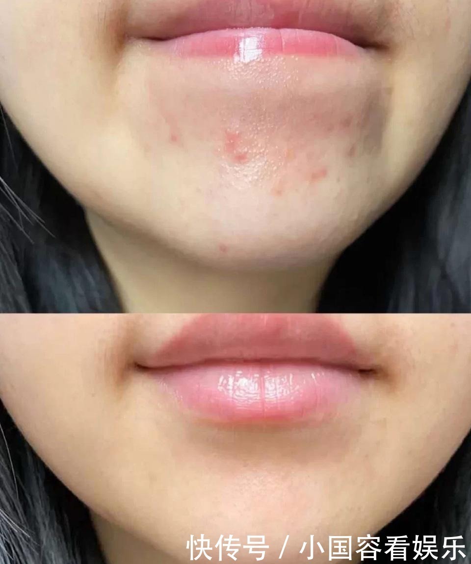 做到这3点,和痘痘肌说再见,让你素颜也很美