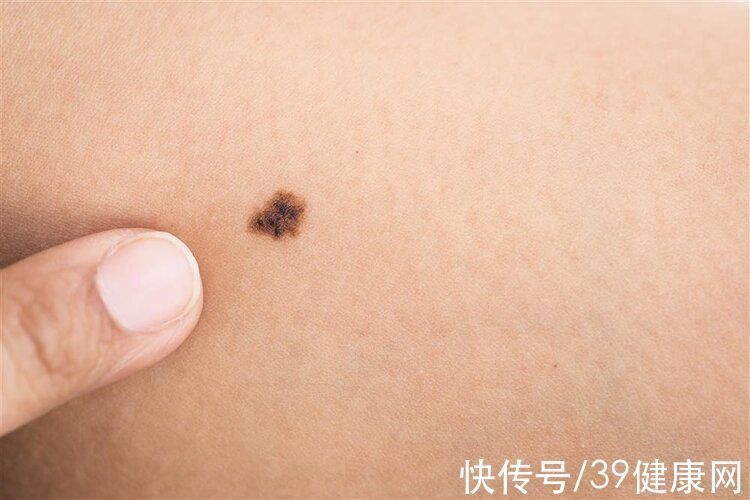 脂褐质|体内有癌,皮肤会通风报信,尽早察觉4个奇怪异样,别拖延