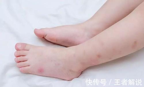 海鲜类|孩子皮肤过敏怎么办?家长们需要知道这些知识