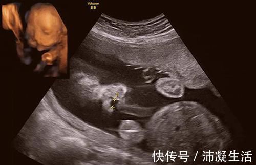 王女士|35岁宝妈怀上“畸形儿”，不顾医生劝告坚持要生，网友：自找苦吃