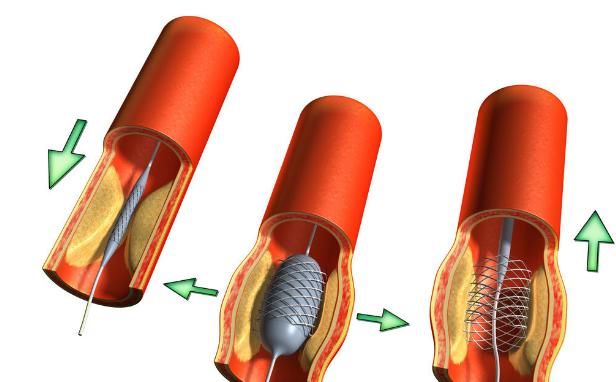 心脏 心脏放了支架活不过15年？辟谣：牢记4个秘诀，让你越活越健康