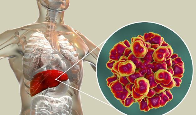 肝脏疾病|肝硬化、肝癌患者如何注意饮食?医生:做到这3点,肝病不敢登门