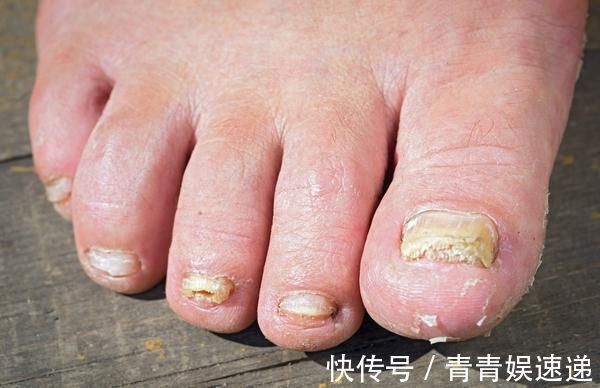 下肢|血糖失控，腿脚会提前“通知”你，这4种迹象提醒你该控糖了