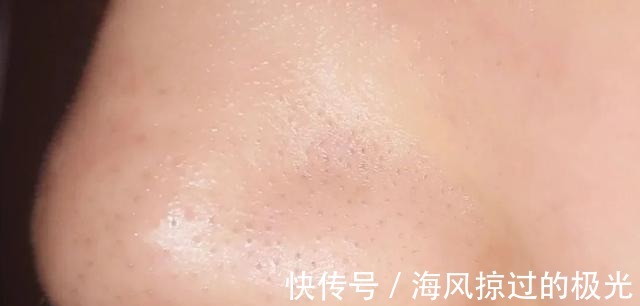 泡沫|看到黑头就想挤担心越挤越多!网上3种方法才损伤皮肤,要避开
