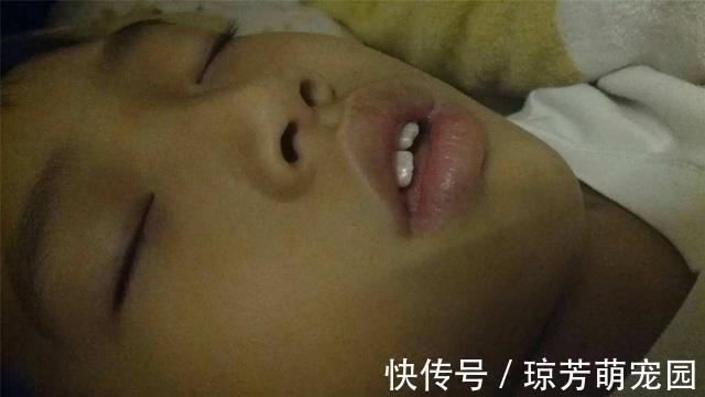 肥胖|女儿爱“张嘴”睡觉,被亲妈用胶布“封嘴”,医生却直夸:做得好