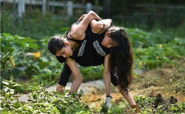 孩子|17年前的连体女婴,医生说“只能活3天”,如今现状超乎众人意料